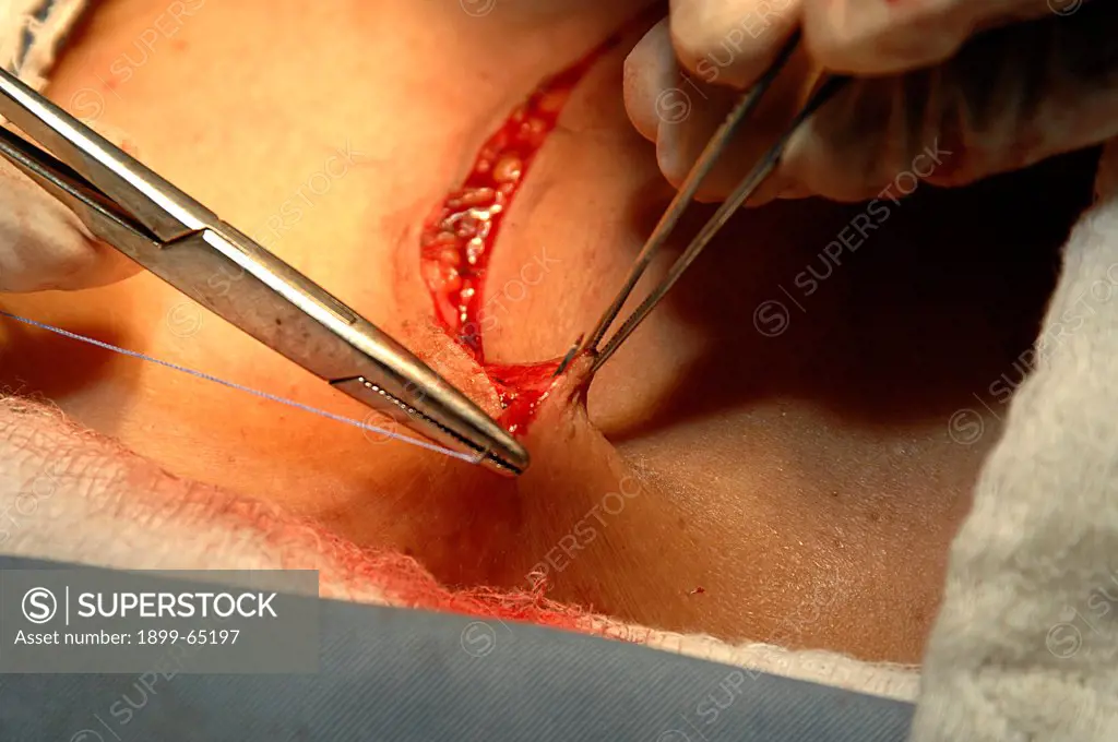 Surgical team stitch wound,