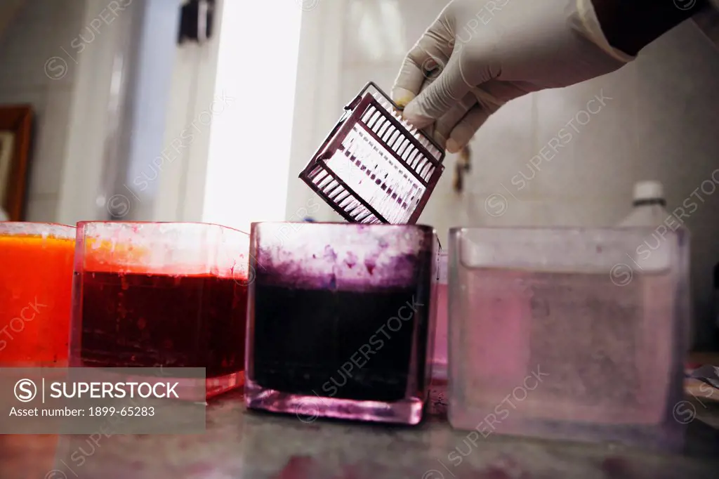 Hand of pathologist removing set of slides from dye