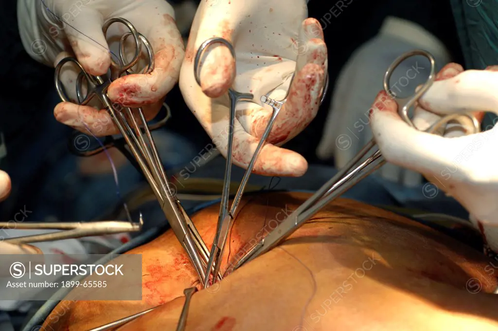 Patient during Cholecystectomy procedure. Sudan, Africa.