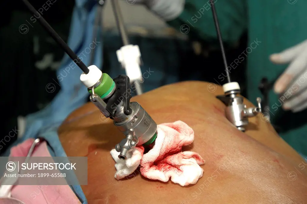 Surgeons performing laparoscopic surgery. Sudan, Africa.