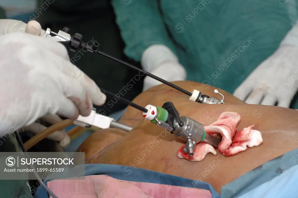 Surgeons performing laparoscopic surgery. Sudan, Africa.