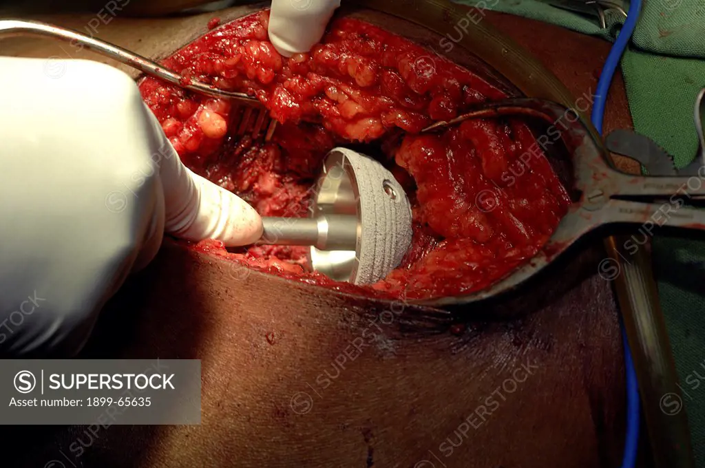 Surgeon inserting acetabular shell during hip replacement