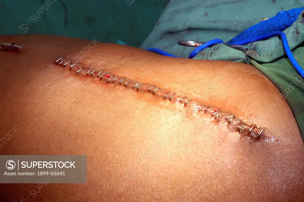 Closed wound after hip replacement