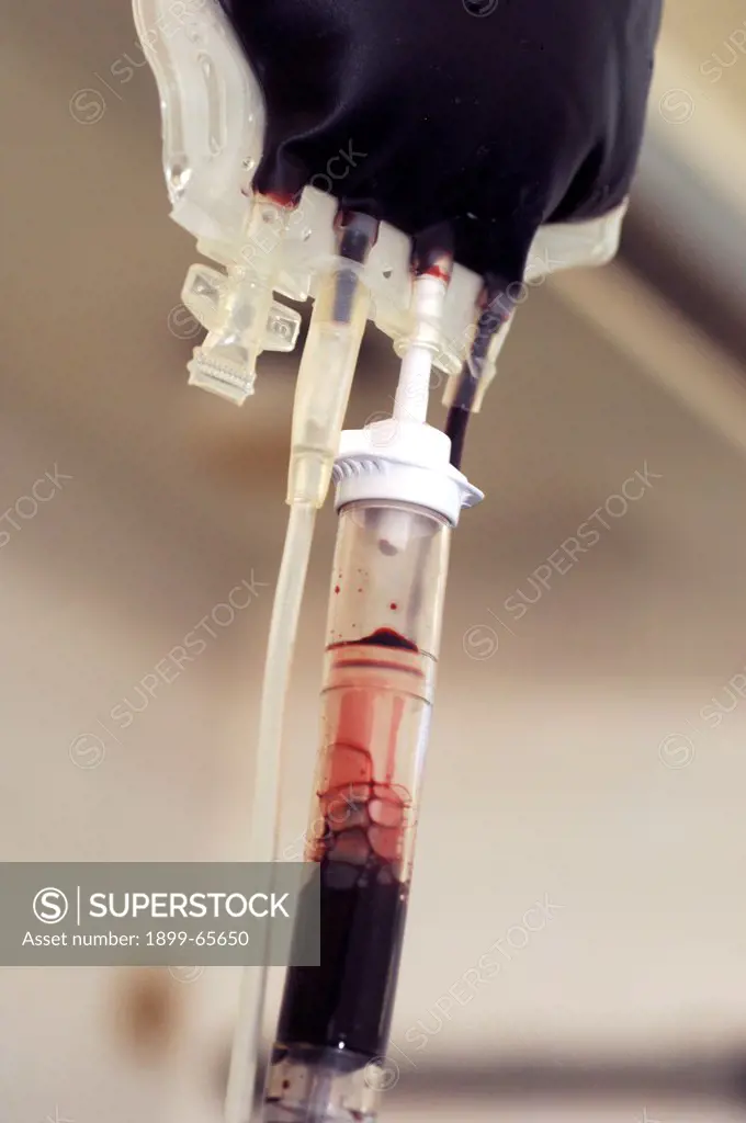 Blood bag being used in blood transfusion. Sudan, Africa.