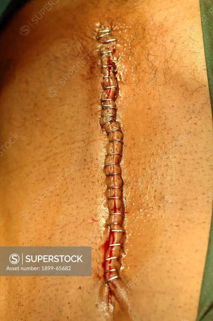 Wound closed with staples