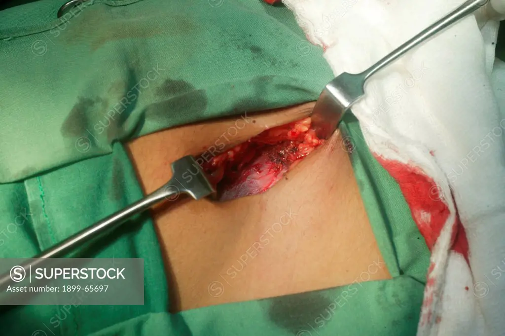 Surgical removal of vermiform appendix