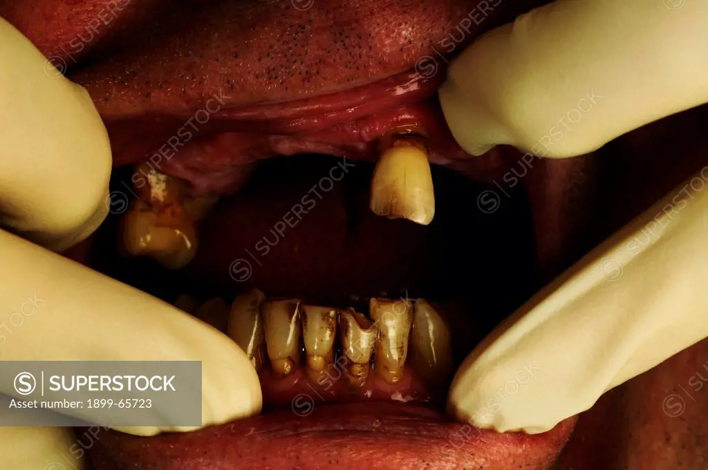 Man having teeth inspected by dentist