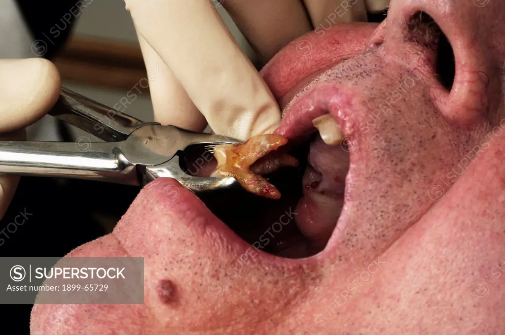 Dentist removing tooth from mans mouth