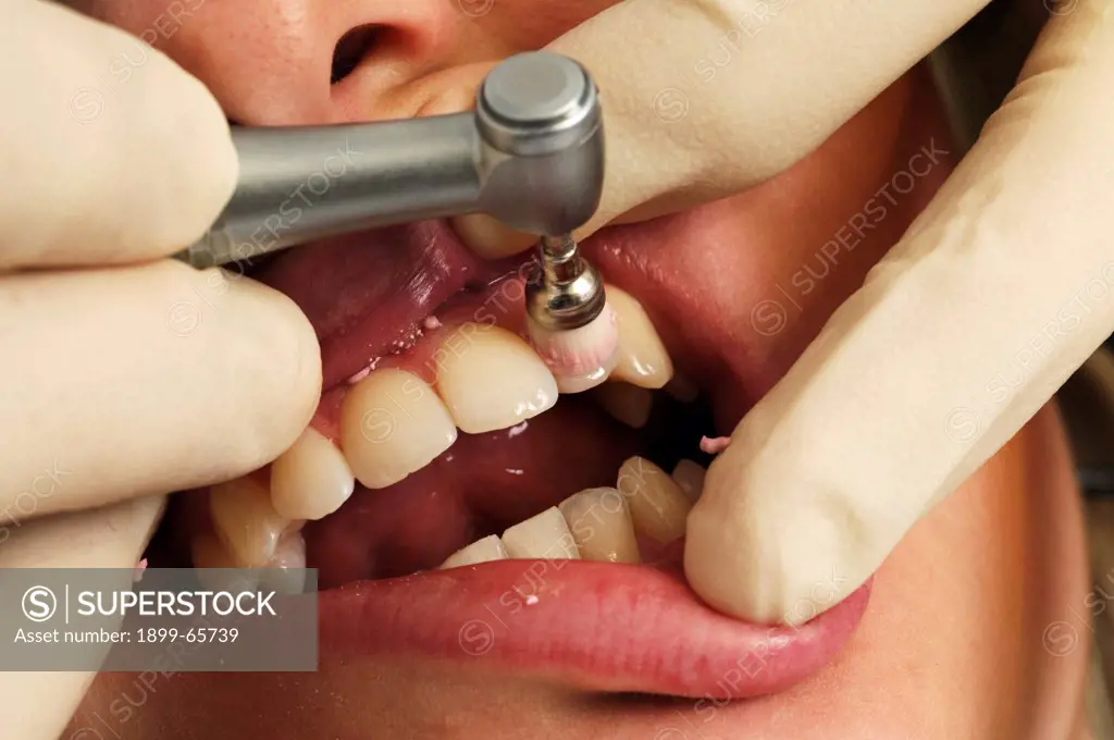 Dentist polishing womens teeth