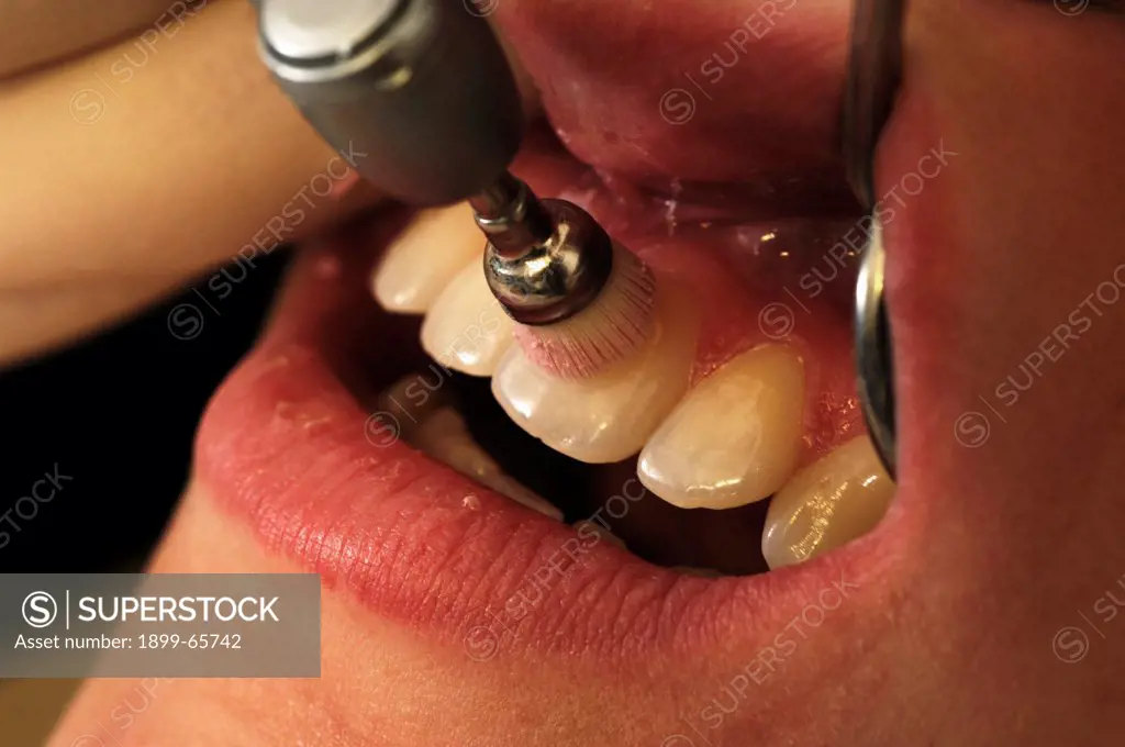 Dentist polishing womens teeth