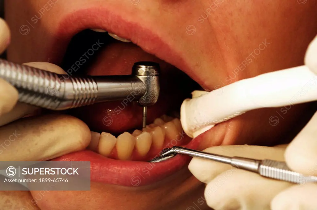 Women is having her teeth cleaned by dentist