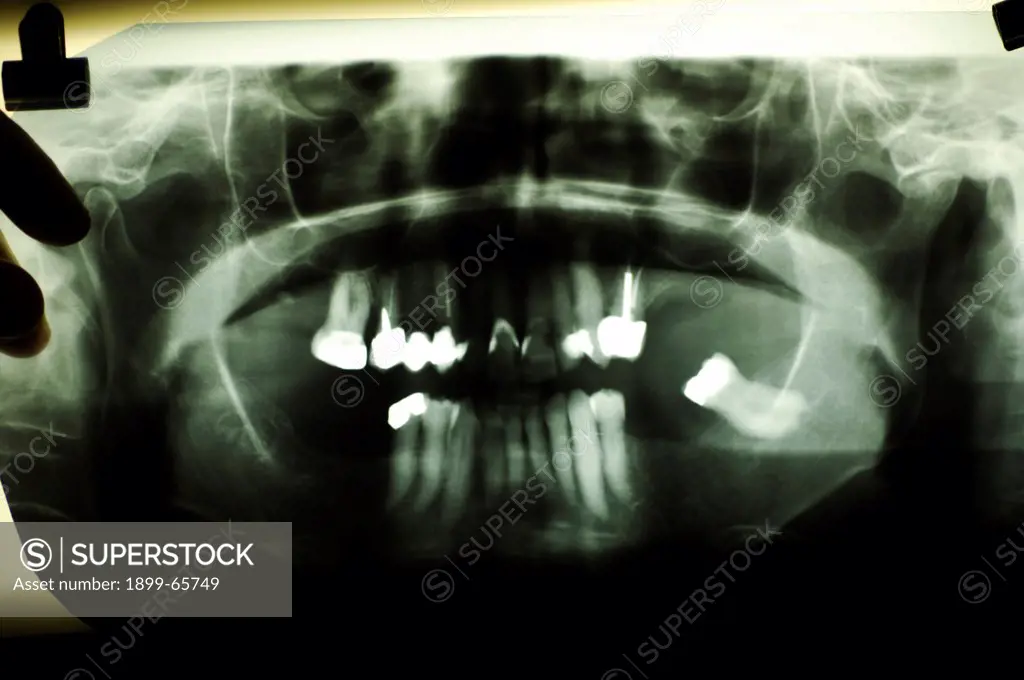 Dental x-rays showing teeth