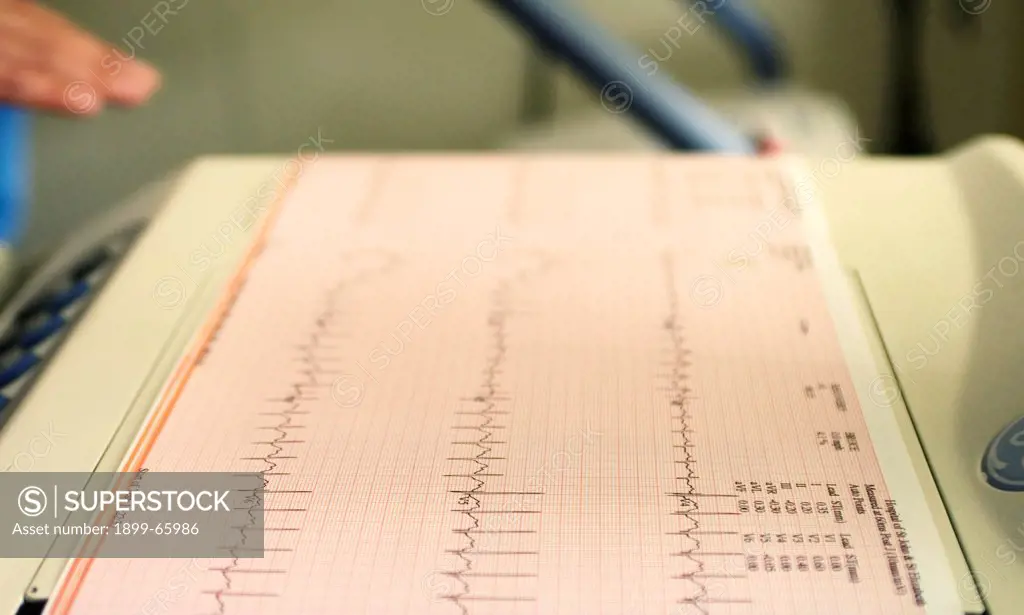Electrocardiogram recording of patients cardiac cycle