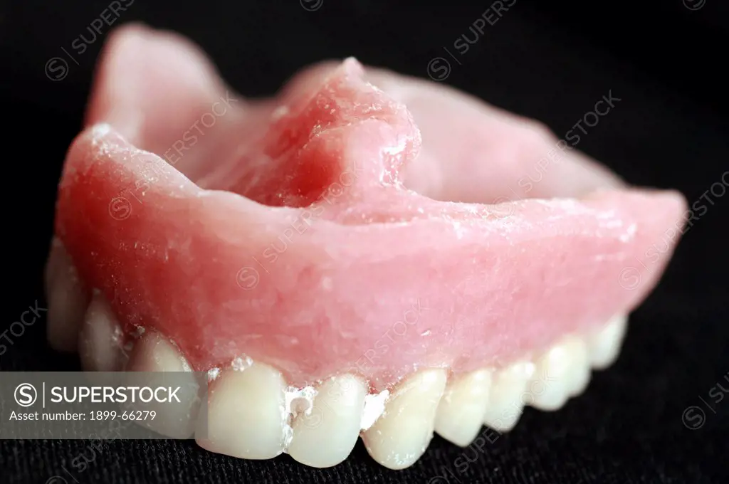 Denture for patient with cleph pallette