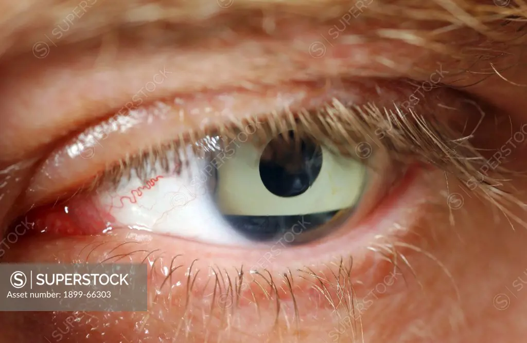 Close up of human eye with corneal implant