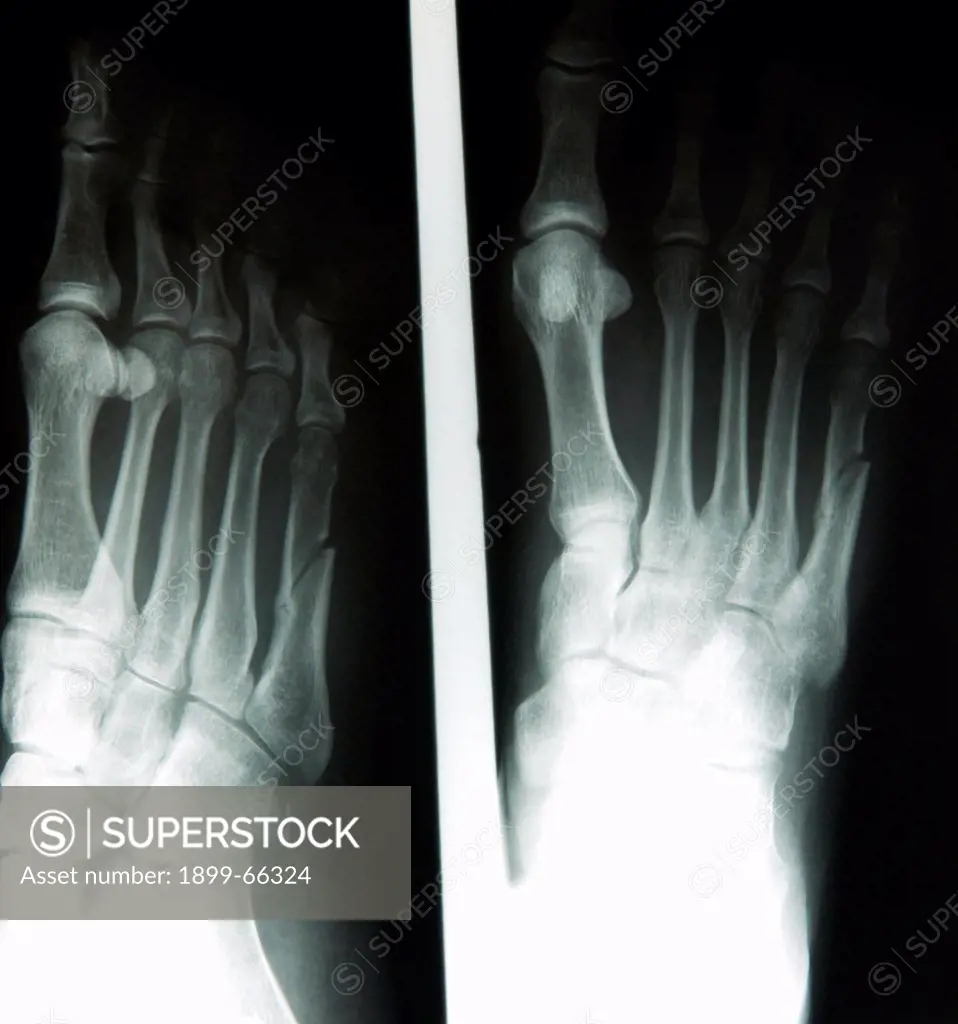 X-ray image of female foot
