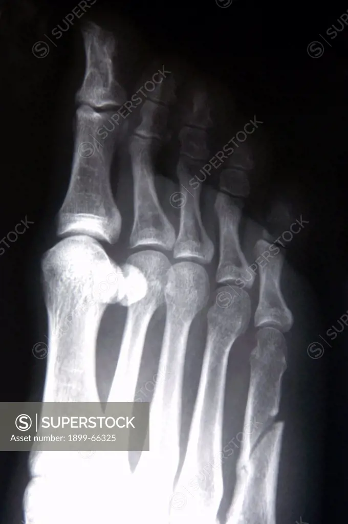 X-ray image image of female foot