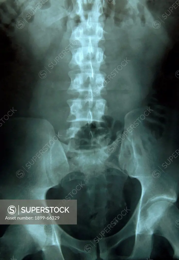 X-ray image of female lumbar vertibrae