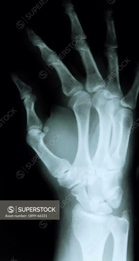 X-ray image of female hand