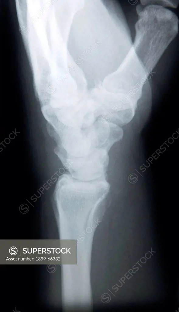 X-ray image of female wrist