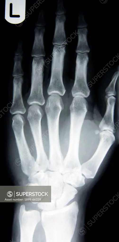 X-ray image of female hand