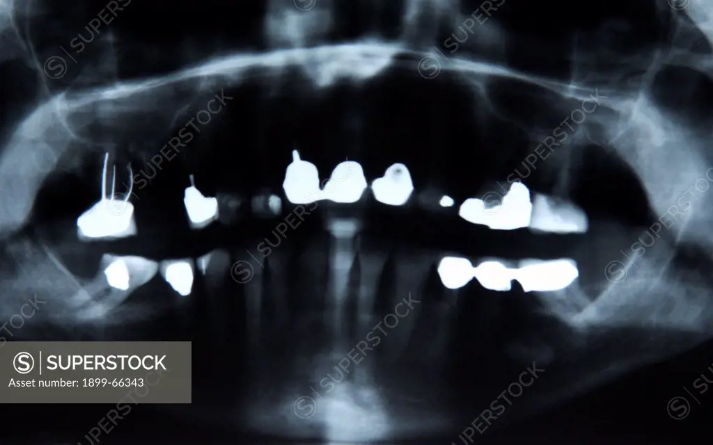 Dentistry X-ray image of female jaw and teeth