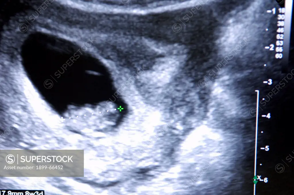 Ultrasound during pregnancy