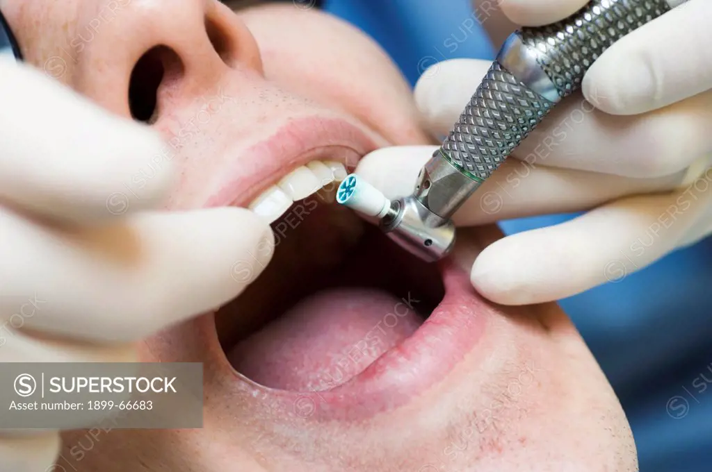 Dentist using drill to remove plaque from teeth of