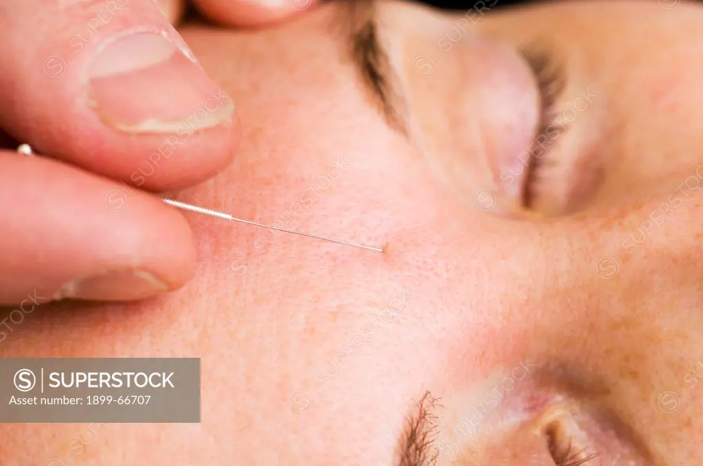 Close-up of therapist fingers inserting acupuncture