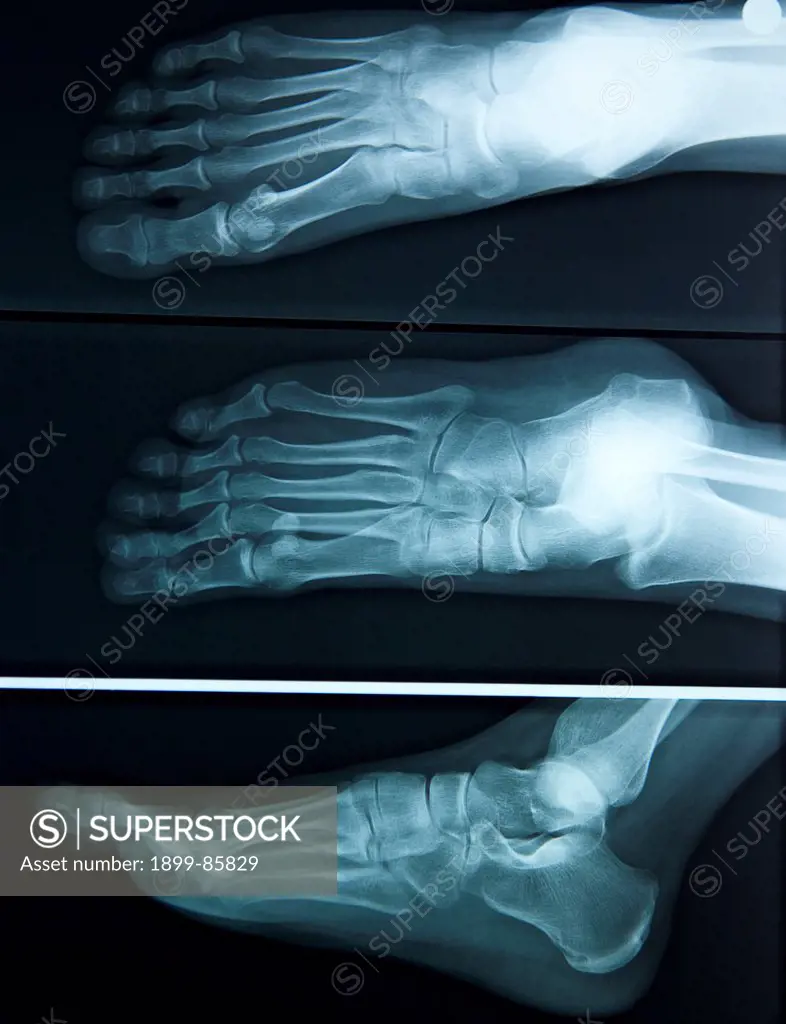 Flat Foot X Ray