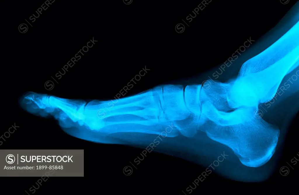 Flat Foot X Ray