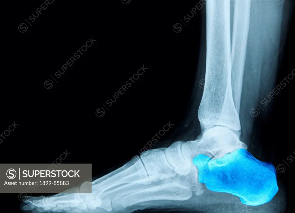 Foot X Ray