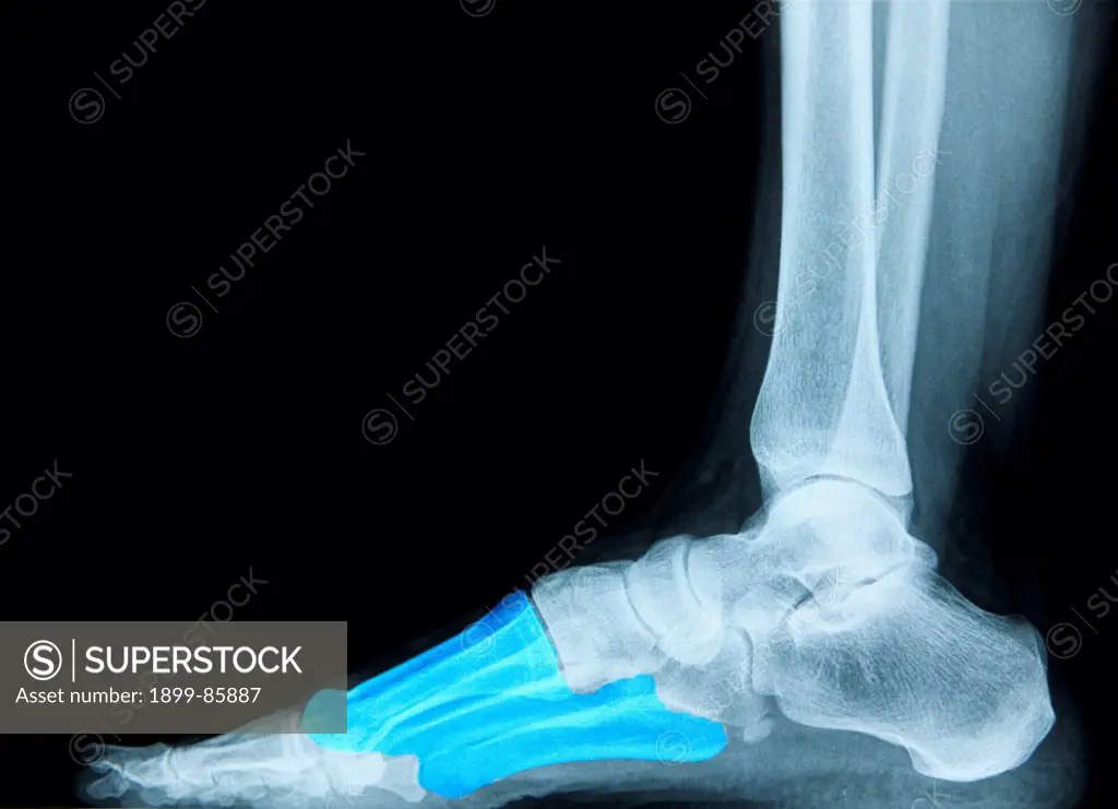 Foot X Ray