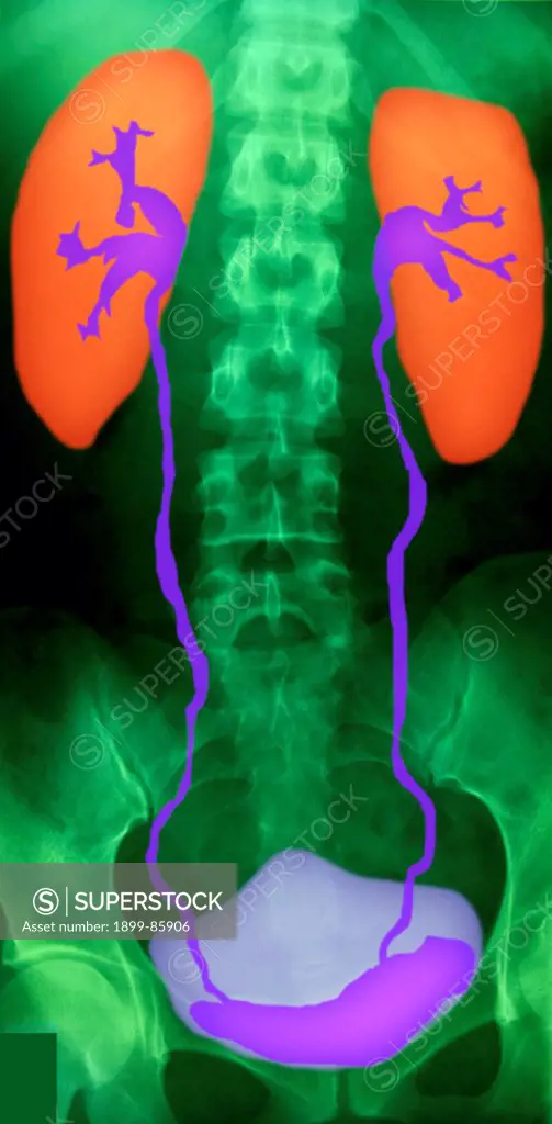 Urinary SysTEM X Ray