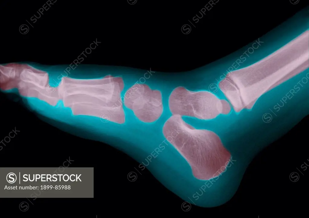 Foot X Ray