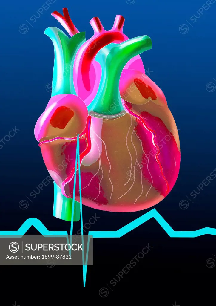Cardiac Rhythm, Illustration