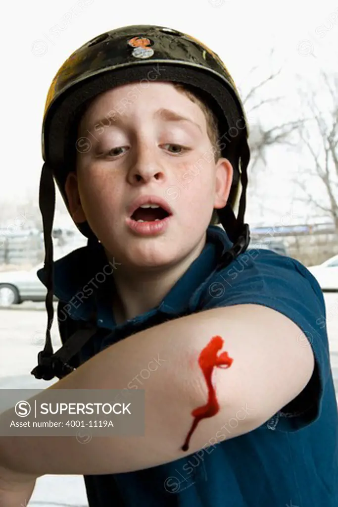 Boy showing his injured elbow