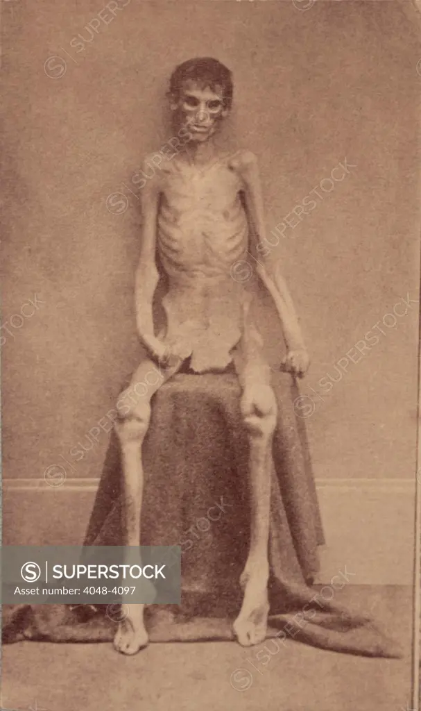 The Civil War, A Federal prisoner, returned from prison, full-length, seated, nude, facing front, 1861-1865.