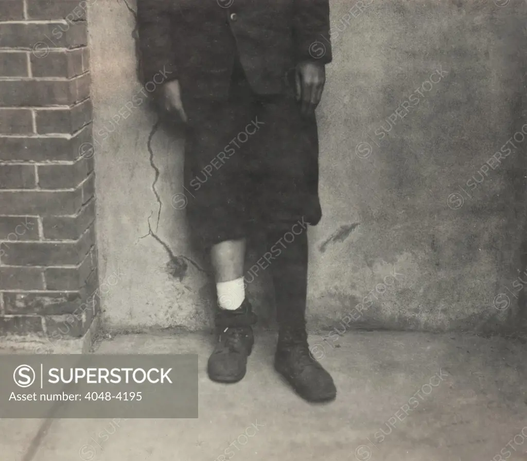 Child labor, Wilfred Levoie, 15 years old, American Linen Company, was pushing and pulling basket along floor; basket caught a loose board and threw him against loom cutting his leg off, Fall River, Massachusetts, photograph by Lewis Wickes Hine, photograph, June 22, 1916.