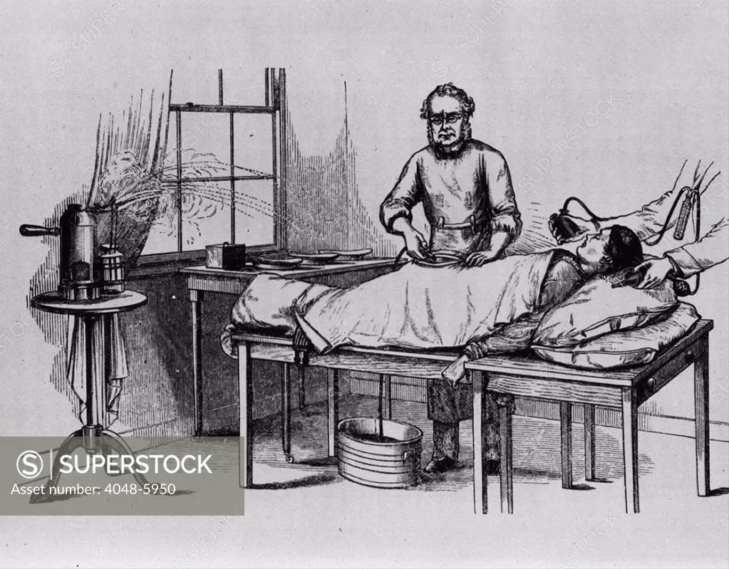 Doctor performing an ovariotomy, the removal of one or both ovaries, using anesthetic and antiseptic steam spray.  In the 1880s doctors sometimes removed of healthy ovaries to treat menstrual madness, neurasthenia (a combination of fatigue, anxiety, headache, neuralgia and depressed mood), and nymphomania. 1882.