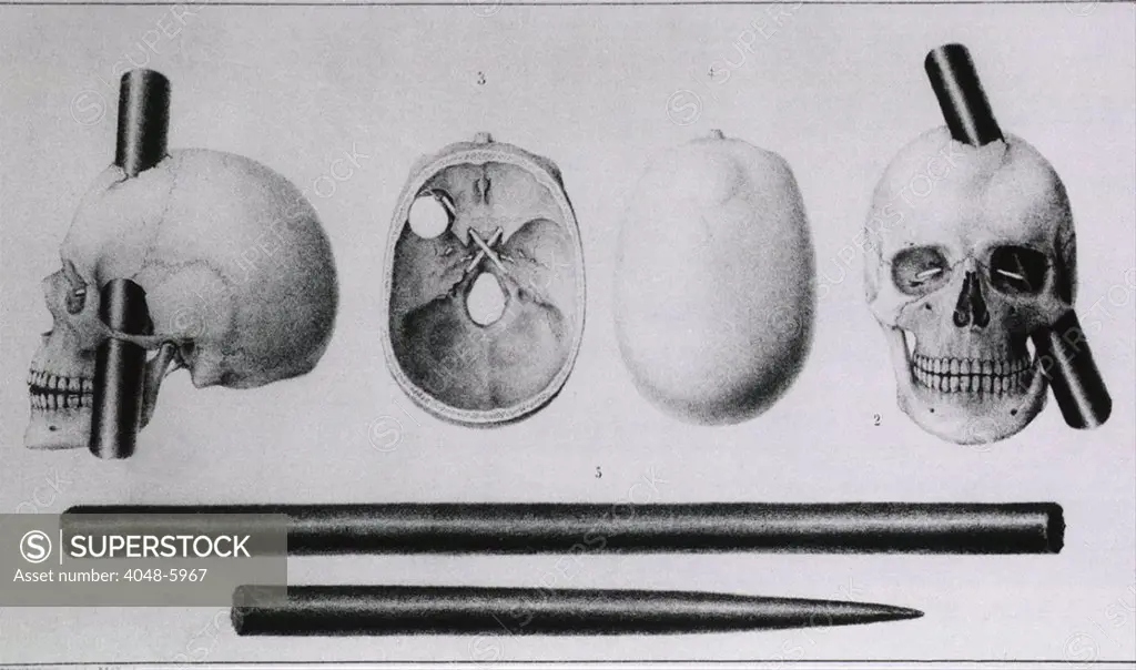 Various views of the famous wound in the skull of Phineas Gage, (1823-1860), showing wound made by iron rod and the rod itself. Gage was a railroad worker when the iron rod was driven completely through his head, into one or both of his brain's frontal lobes. Gage's physical recovery was complete, but his mental recovery was not. He died of injury related convulsions in 1860. His case informed scientists about the functions of different parts of the brain.