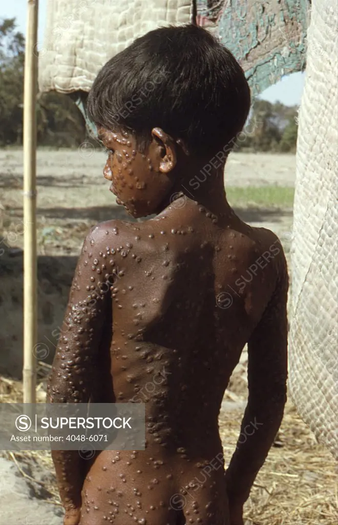Bangladeshi youth with Smallpox in 1974, has the typical rash covering his entire body with pustules. The last naturally occurring case in the world was in Somalia in 1977.