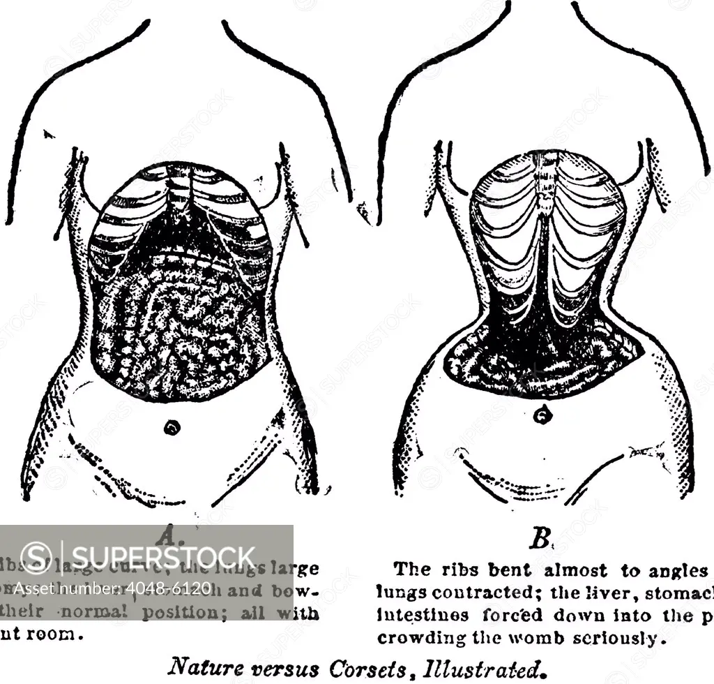 'Nature Versus Corsets.' At left is the natural arrangement of a woman's internal anatomy, contrasted with the corset's effects on the internal organs and bones. From GOLDEN THOUGHTS ON CHASTITY AND PROCREATION, by John Gibson, 1903.
