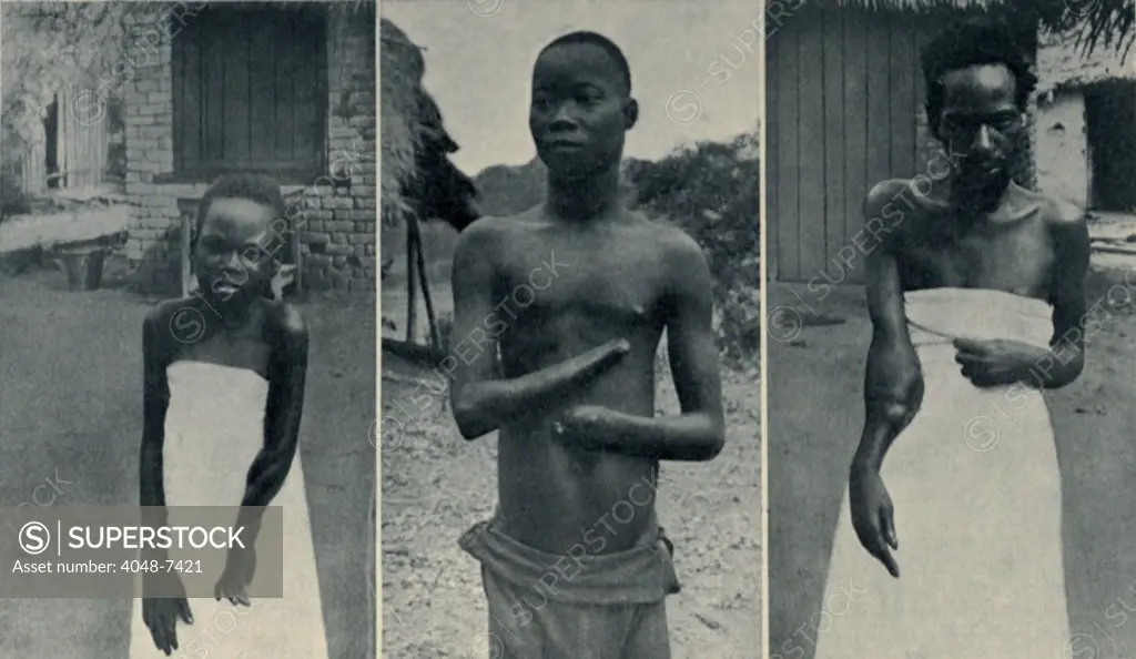 Atrocities of the Rubber Slavery in the Belgian Congo. Mongala (left) and Biasia (right) arms were shattered by gunshots of 'rubber sentries' who attacked their village when it failed to meet its rubber tax quota. Mola Enuliti's (center) hands were smashed by sentries' rifle butts.