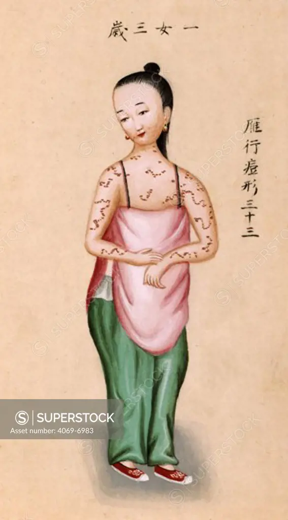 Young Chinese girl with smallpox, illustration from 'Notes on Diverse Eruptions, ' 1786.