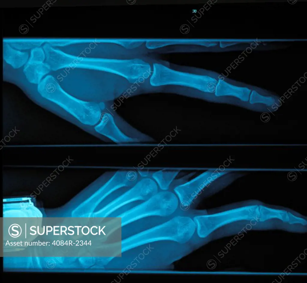 X-Ray of 12 year old Girl's Hand