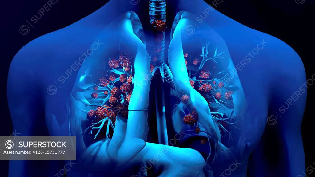 Coronavirus lung infection, conceptual illustration