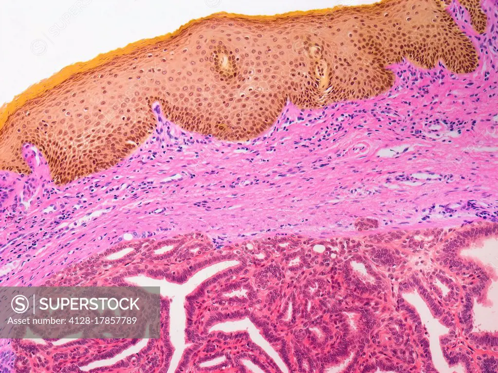 Hidradenoma papilliferum, light micrograph (LM) of a section of affected vulva. Hidradenoma papilliferumis a type of benign cystic papillary growth (l...