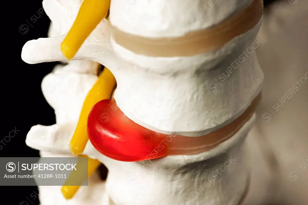 Slipped disc. Spinal model demonstrating a slipped intervertebral disc. The slipped disc is the red, near the base of the spine. One of the discs of c...