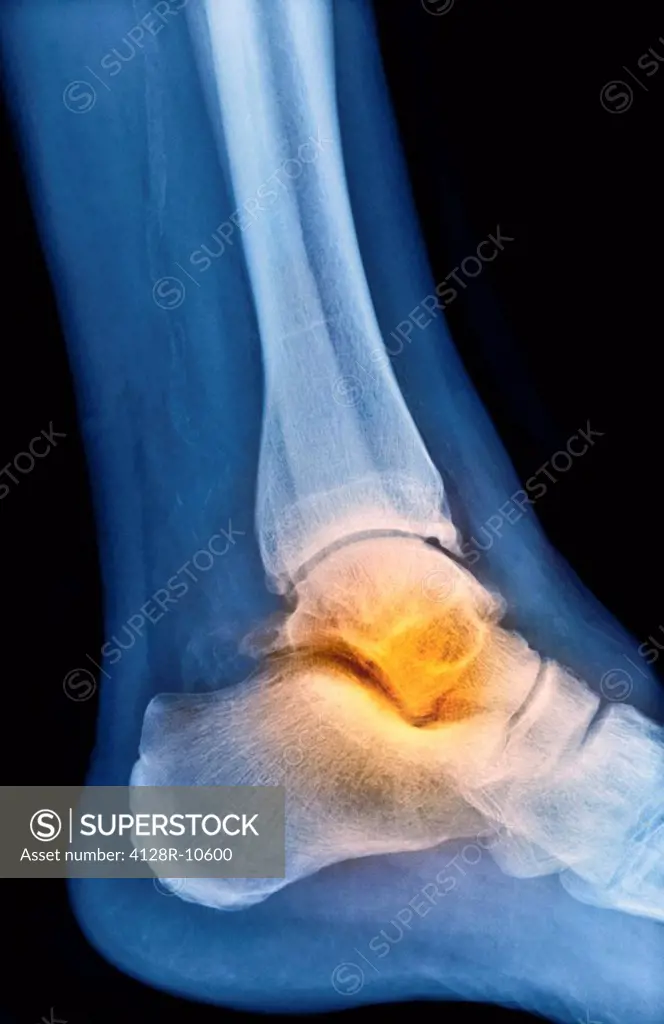 Arthritic ankle, X_ray